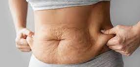 Liposuction/ Fat Grafting